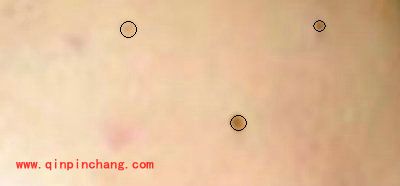 iSee图片专家如何祛除脸上痘痘