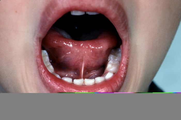TongueTied 1.3.2