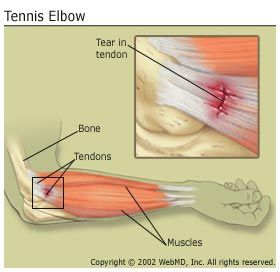 Tennis Elbow 2011 1.0 Build 71